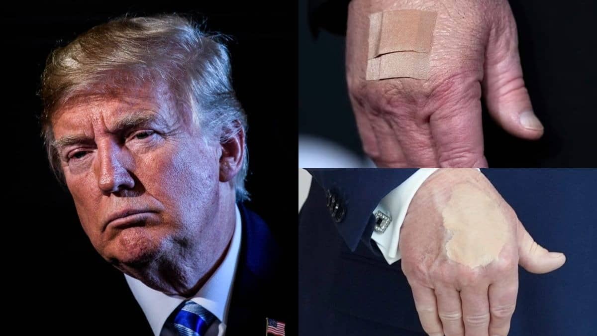 What Is The Mystery Behind Bandages & Bruises on Trump’s Hands?